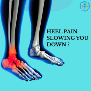 Plantar Fasciitis